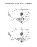 Naso-gastric mask and method diagram and image