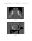 METHOD FOR THE RECONSTRUCTION OF A PANORAMIC IMAGE OF AN OBJECT, AND A COMPUTED TOMOGRAPHY SCANNER IMPLEMENTING SAID METHOD diagram and image