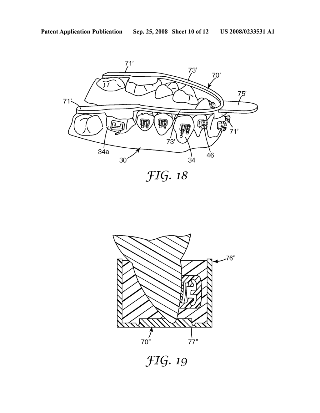 METHODS AND ASSEMBLIES FOR MAKING AN ORTHODONTIC BONDING TRAY USING RAPID PROTOTYPING - diagram, schematic, and image 11