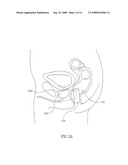 Mri Probe for Prostate Imaging diagram and image