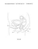 Mri Probe for Prostate Imaging diagram and image