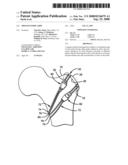 Trochanteric grip diagram and image