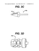 Tissue Extraction and Collection Device diagram and image