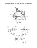 Devices, Systems and Methods for Treating Disorders of the Ear, Nose and Throat diagram and image