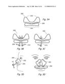 Devices, Systems and Methods for Treating Disorders of the Ear, Nose and Throat diagram and image