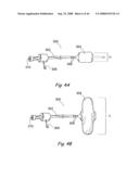 Devices, Systems and Methods for Treating Disorders of the Ear, Nose and Throat diagram and image