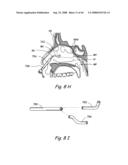 Devices, Systems and Methods for Treating Disorders of the Ear, Nose and Throat diagram and image