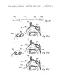 Devices, Systems and Methods for Treating Disorders of the Ear, Nose and Throat diagram and image