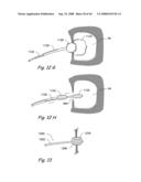 Devices, Systems and Methods for Treating Disorders of the Ear, Nose and Throat diagram and image