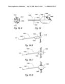 Devices, Systems and Methods for Treating Disorders of the Ear, Nose and Throat diagram and image