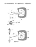 Devices, Systems and Methods for Treating Disorders of the Ear, Nose and Throat diagram and image