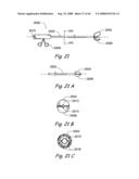 Devices, Systems and Methods for Treating Disorders of the Ear, Nose and Throat diagram and image