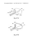 Devices, Systems and Methods for Treating Disorders of the Ear, Nose and Throat diagram and image