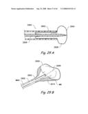 Devices, Systems and Methods for Treating Disorders of the Ear, Nose and Throat diagram and image