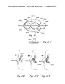 Devices, Systems and Methods for Treating Disorders of the Ear, Nose and Throat diagram and image