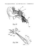 Devices, Systems and Methods for Treating Disorders of the Ear, Nose and Throat diagram and image