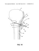 Surgical plate puller devices and methods for use with surgical bone screw/plate systems diagram and image