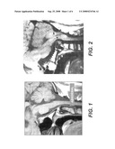 CRANIOSPINAL FUSION METHOD AND APPARATUS diagram and image