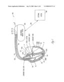 CLOSED-LOOP RESYNCHRONIZATION THERAPY FOR MECHANICAL DYSSYNCHRONY diagram and image