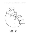 CLOSED-LOOP RESYNCHRONIZATION THERAPY FOR MECHANICAL DYSSYNCHRONY diagram and image