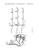 CLOSED-LOOP RESYNCHRONIZATION THERAPY FOR MECHANICAL DYSSYNCHRONY diagram and image