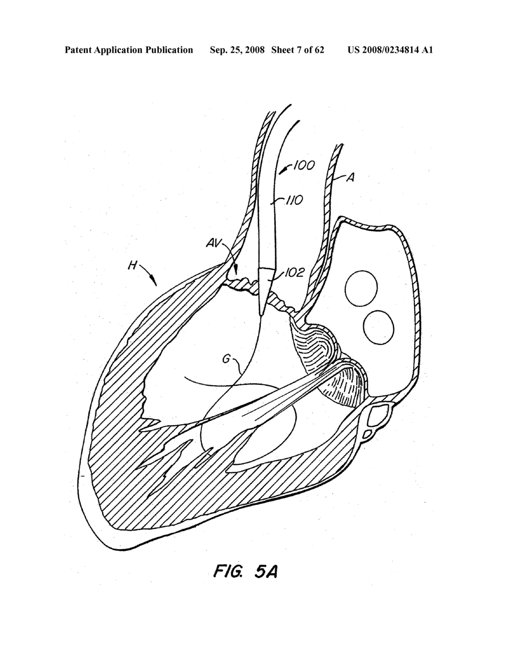 Low Profile Heart Valve and Delivery System - diagram, schematic, and image 08