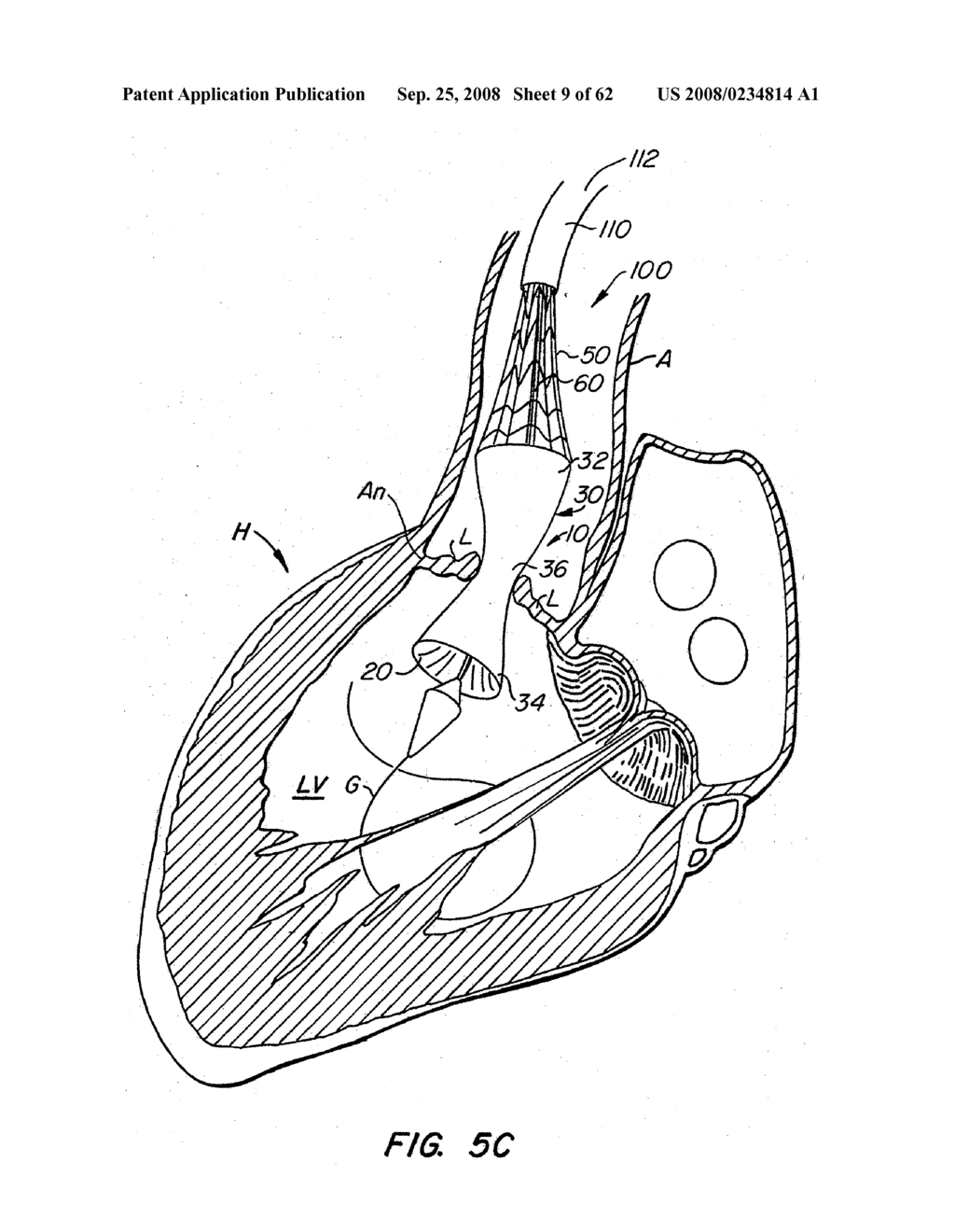 Low Profile Heart Valve and Delivery System - diagram, schematic, and image 10