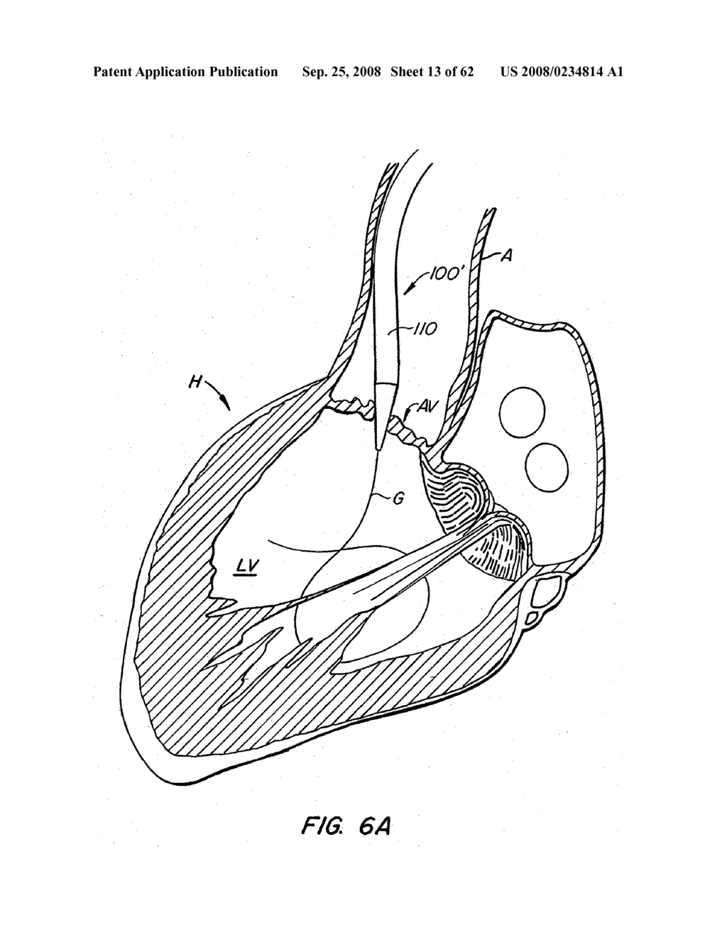 Low Profile Heart Valve and Delivery System - diagram, schematic, and image 14