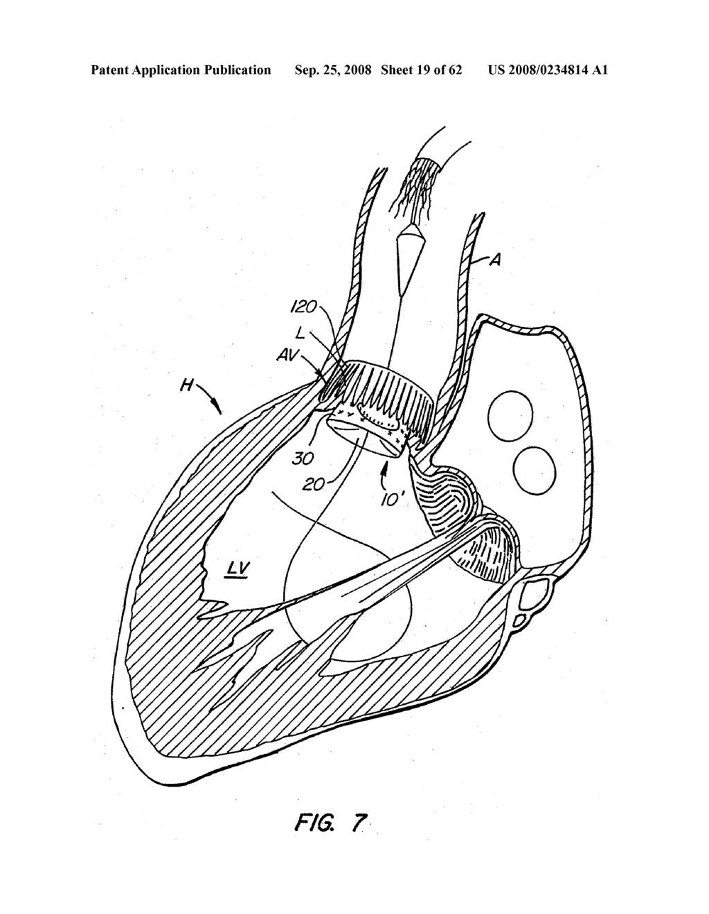 Low Profile Heart Valve and Delivery System - diagram, schematic, and image 20