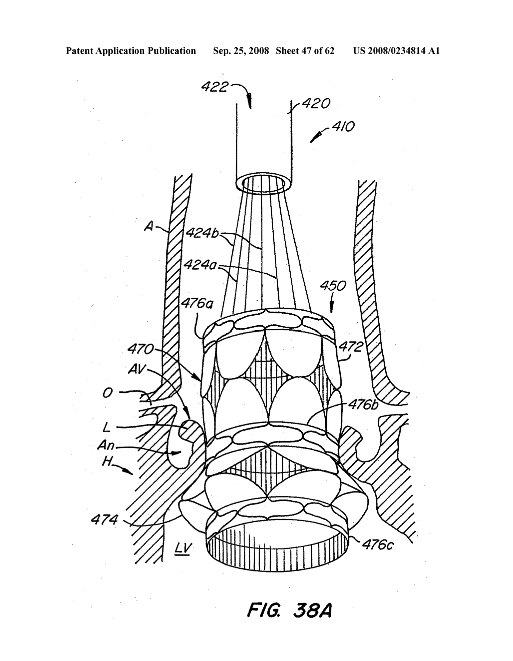 Low Profile Heart Valve and Delivery System - diagram, schematic, and image 48