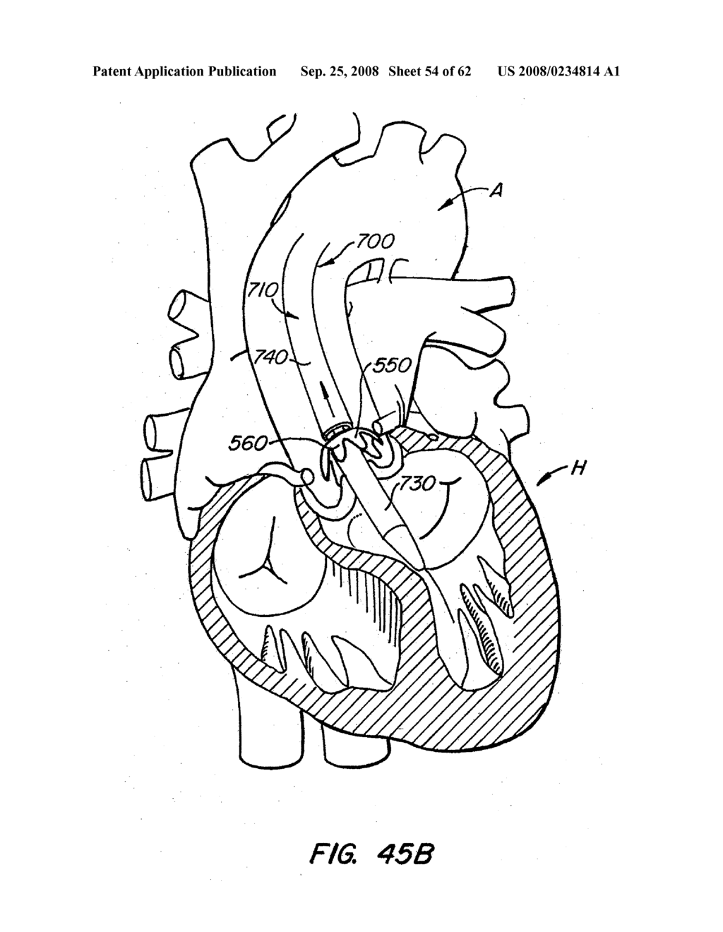 Low Profile Heart Valve and Delivery System - diagram, schematic, and image 55