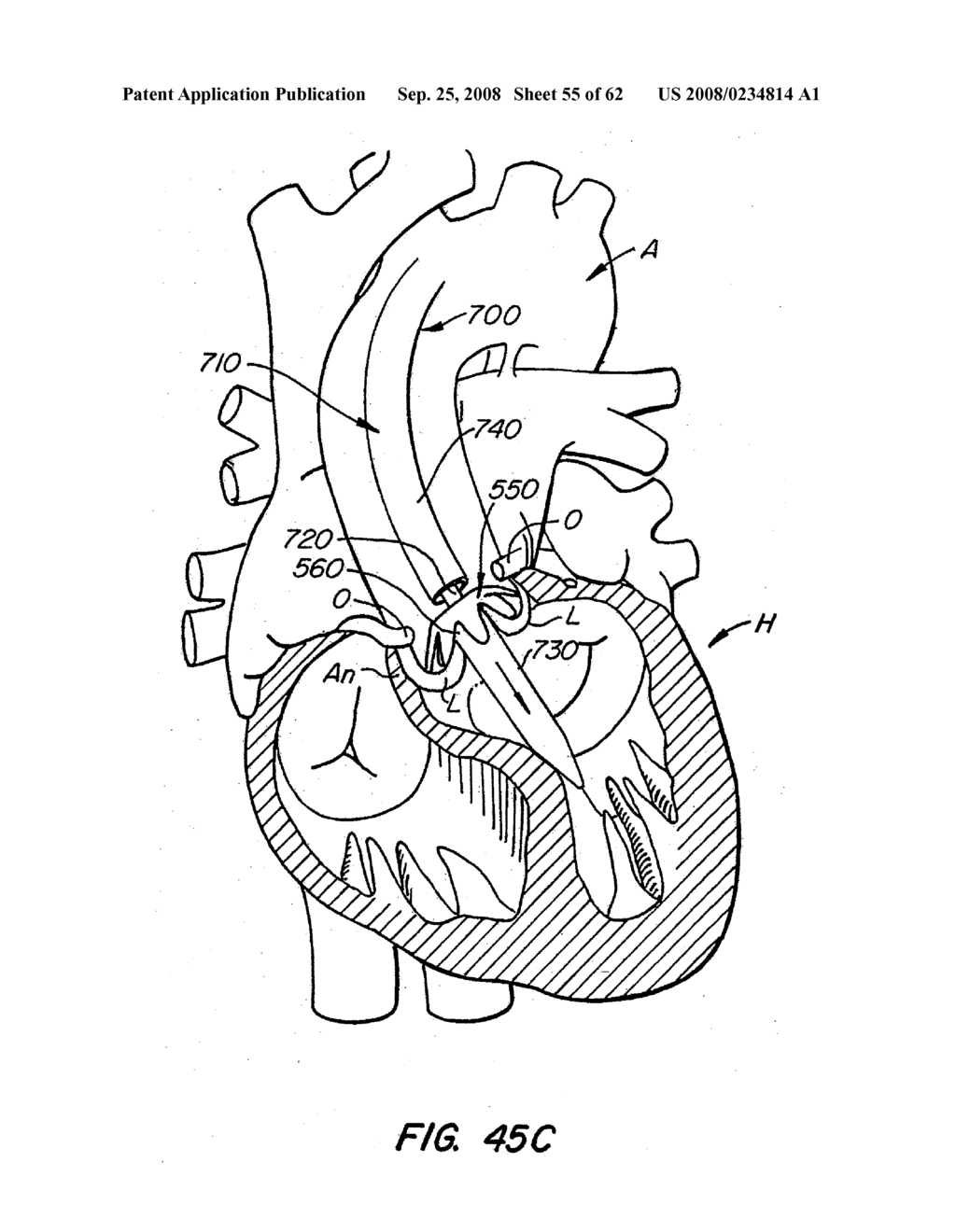 Low Profile Heart Valve and Delivery System - diagram, schematic, and image 56