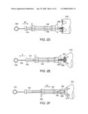 Gastrointestinal implant with drawstring diagram and image