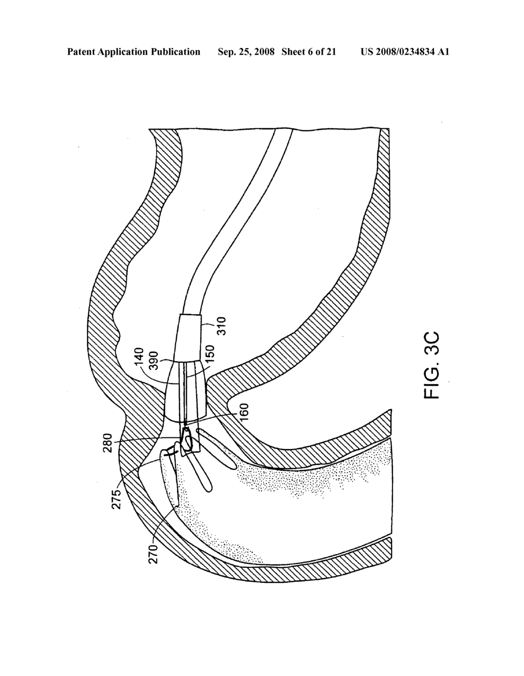 Gastrointestinal implant with drawstring - diagram, schematic, and image 07