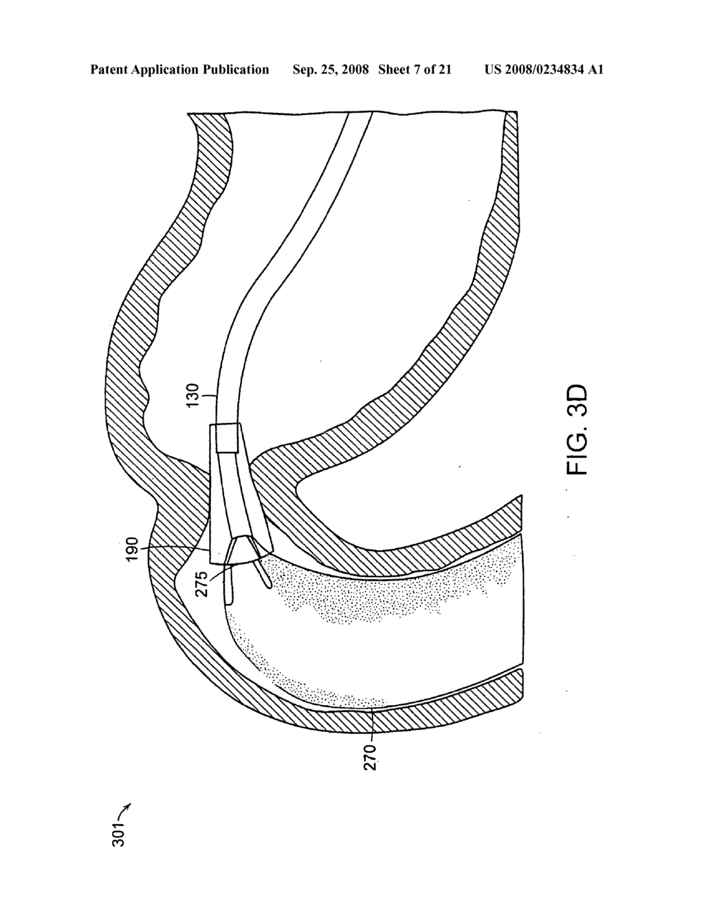 Gastrointestinal implant with drawstring - diagram, schematic, and image 08