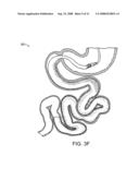 Gastrointestinal implant with drawstring diagram and image