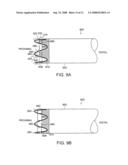 Gastrointestinal implant with drawstring diagram and image