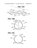 LOCAL VASCULAR DELIVERY OF PROBUCOL ALONE OR IN COMBINATION WITH SIROLIMUS TO TREAT RESTENOSIS, VULNERABLE PLAQUE, AAA AND STROKE diagram and image