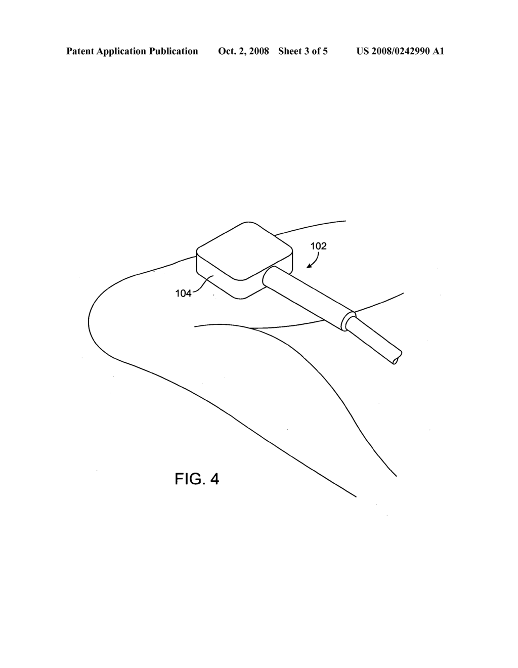 Hair removal using focused high intensity acoustic energy - diagram, schematic, and image 04