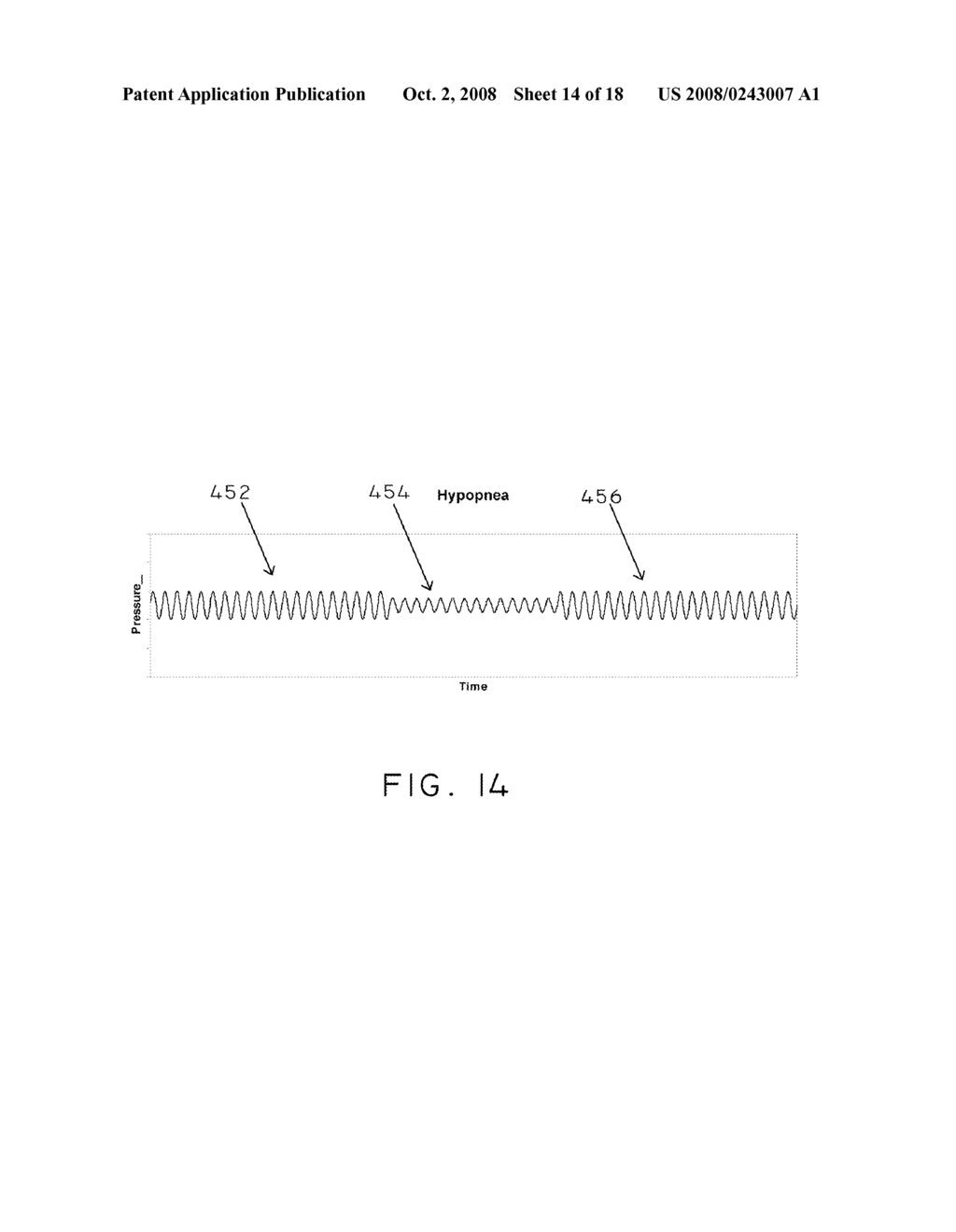 Pulmonary Artery Pressure Signals And Methods of Using - diagram, schematic, and image 15