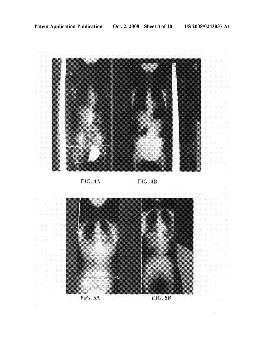 Therapeutic method for scolioses - diagram, schematic, and image 04