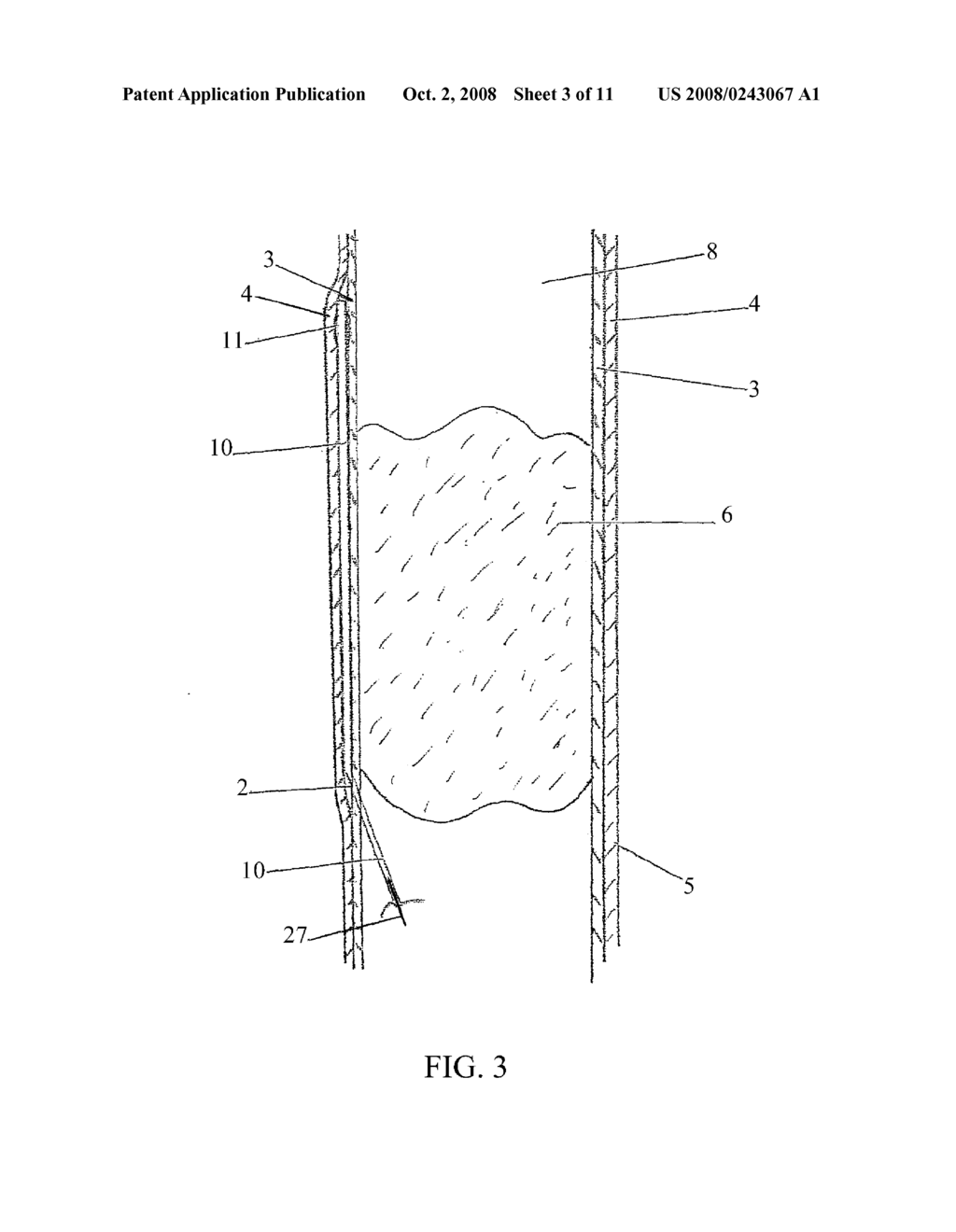 LUMEN REENTRY DEVICES AND METHODS - diagram, schematic, and image 04