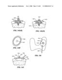 Surgical Tools for Arthroplasty diagram and image