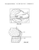 Surgical Tools for Arthroplasty diagram and image