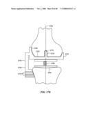 Surgical Tools for Arthroplasty diagram and image