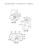 Surgical Tools for Arthroplasty diagram and image