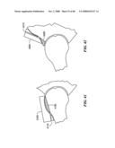 Surgical Tools for Arthroplasty diagram and image