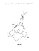 Surgical Tools for Arthroplasty diagram and image