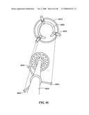 Surgical Tools for Arthroplasty diagram and image