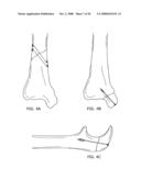 Adjustable bone plate fixation system and metho diagram and image